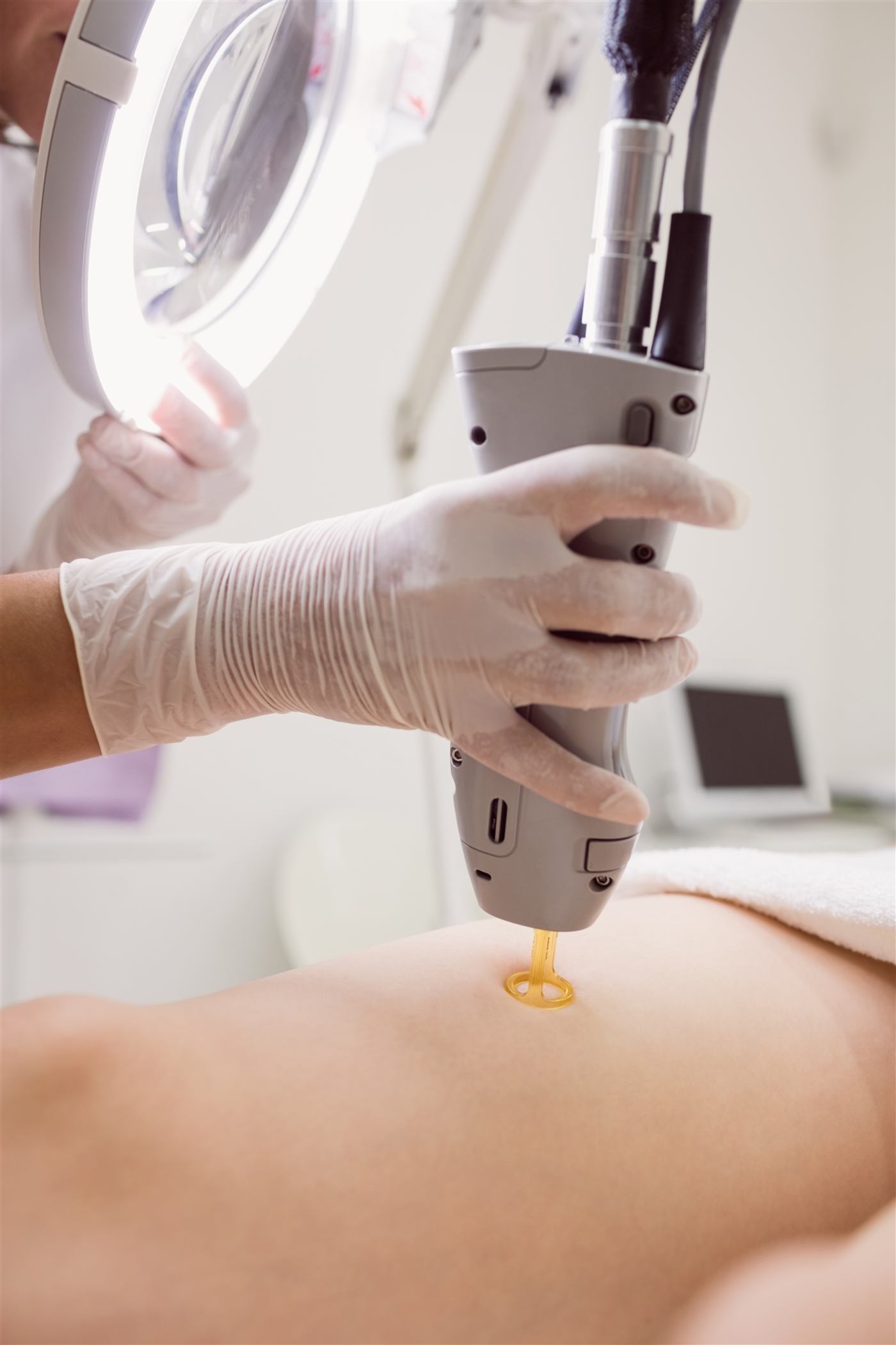 Depilação a laser sendo aplicada em clínica